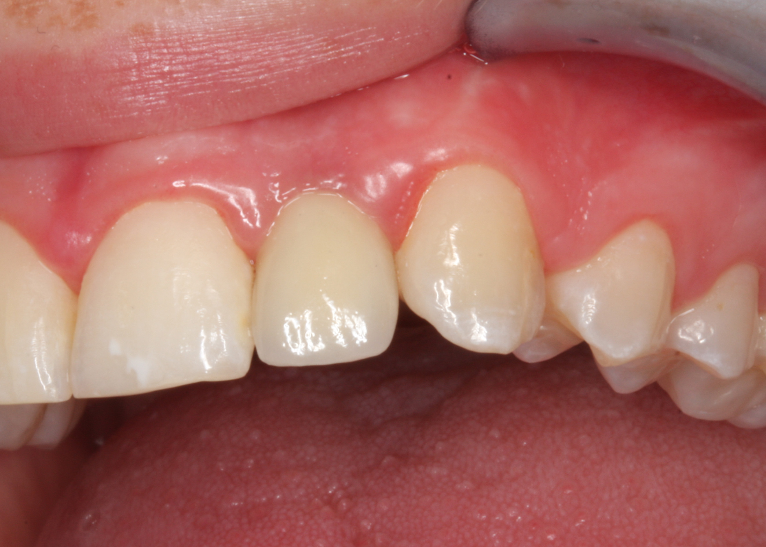Zahnarzt Hildesheim bietet optimale Ästhetik mit Implantatene